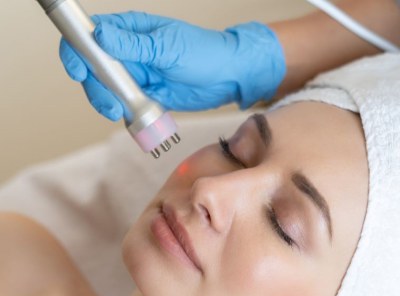 Radiofrekwencja mikroigłowa – sposób na jędrną i młodą skórę